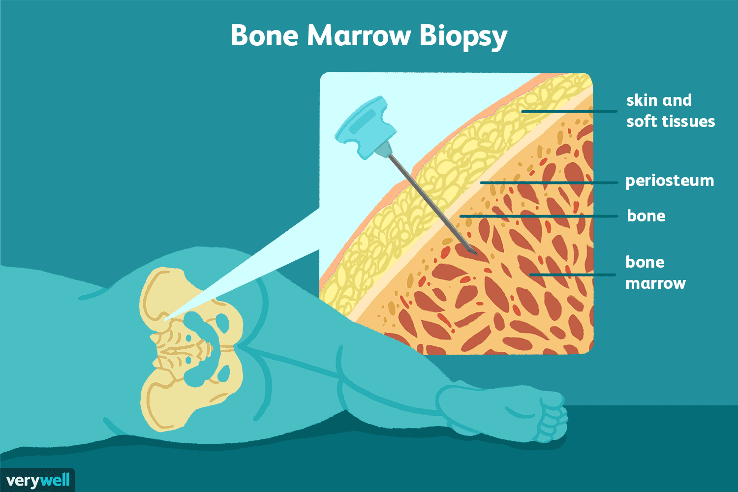 bone marrow biopsy