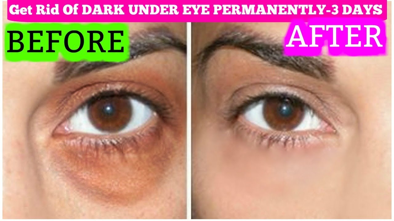 how to remove dark circles