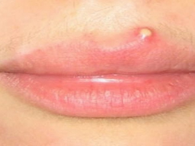 pimple on lip