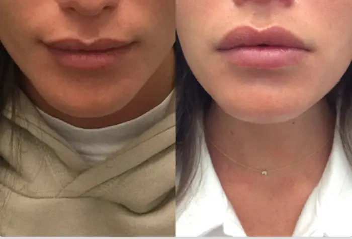 botox lip flip before and after