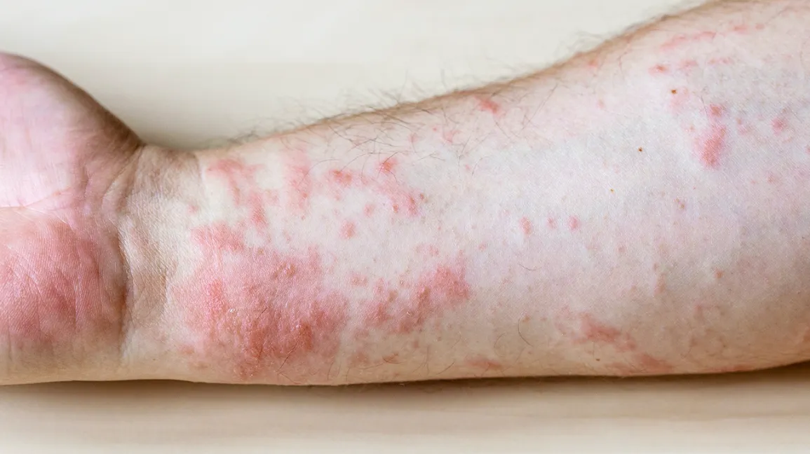 Causes of Red Spots On Skin