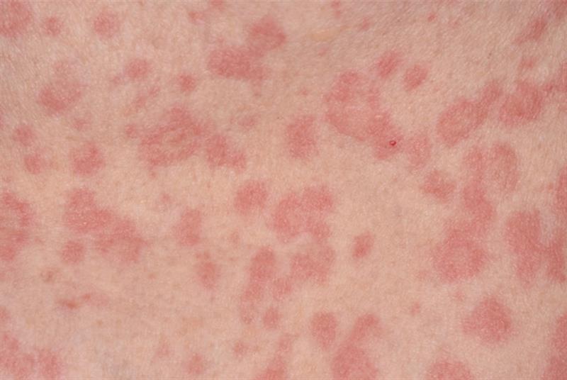Causes of Red Spots On Skin