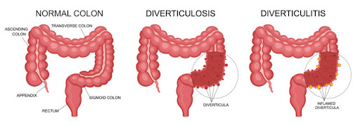 foods to avoid with Diverticulitis